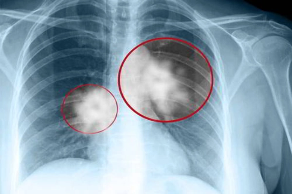 Phát hiện u phổi lành tính nhờ chụp X-quang ngực